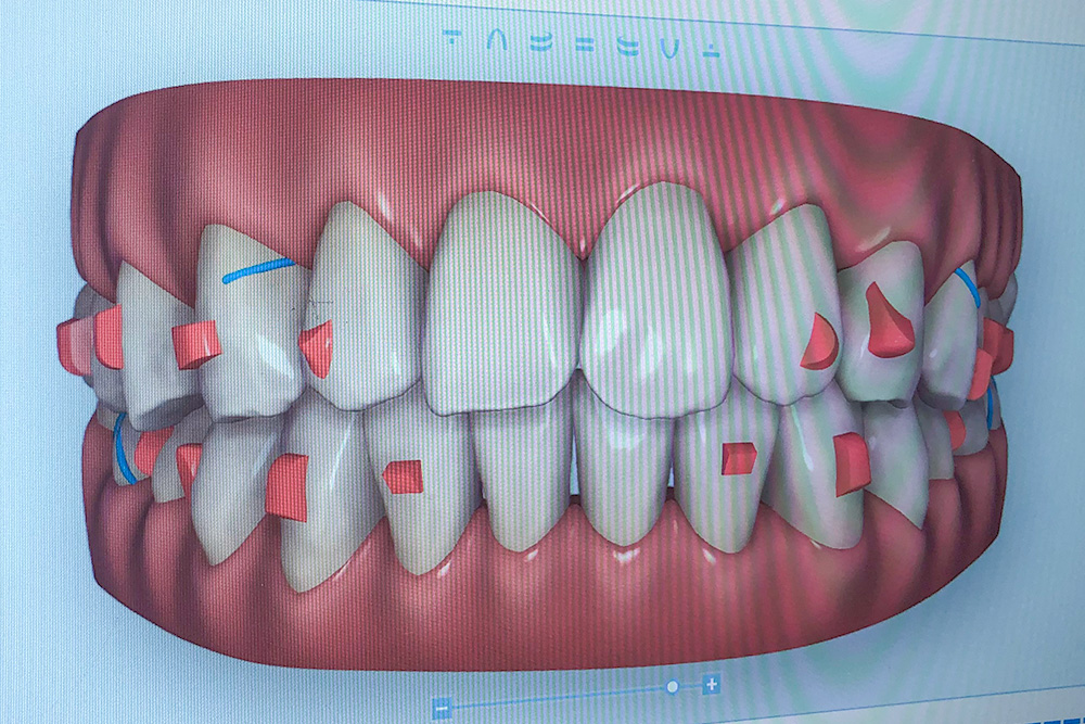 インビザライン矯正のアタッチメント